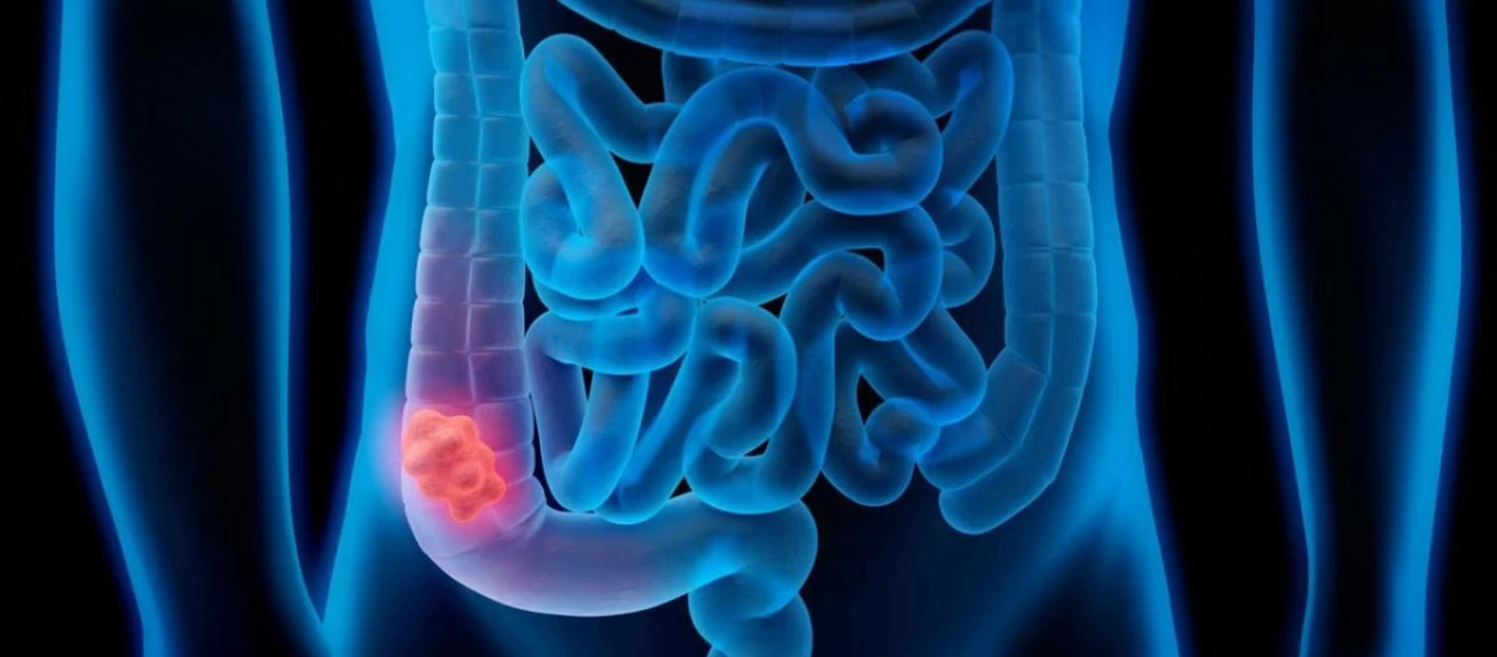 Καρκίνος Παχέος Εντέρου: Αυτό είναι το μεγαλύτερο αίτιο εμφάνισής του